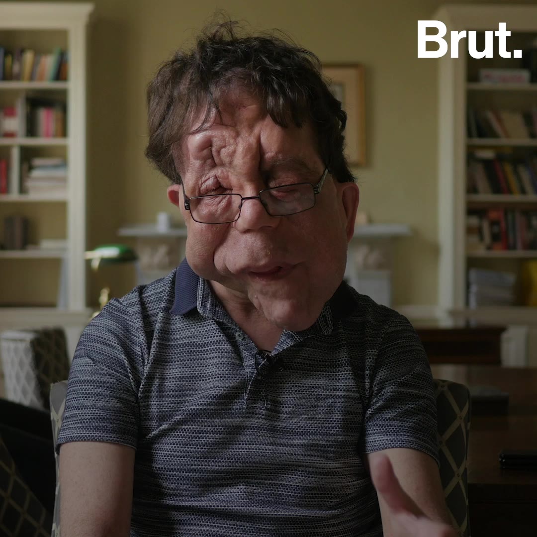 Adam Pearson On Disability Rights And Social Media Brut