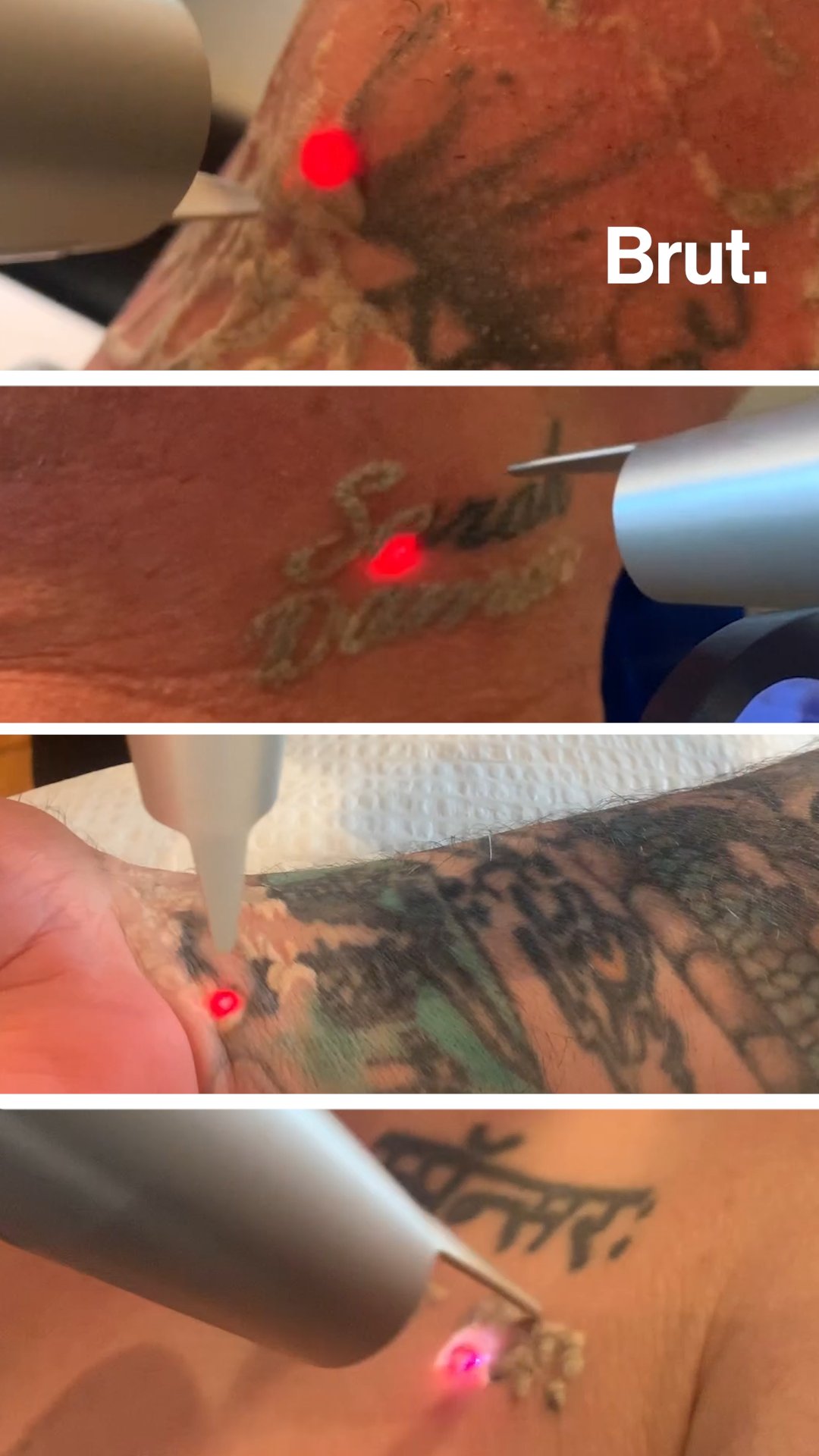 Free tattoo removal to transform lives