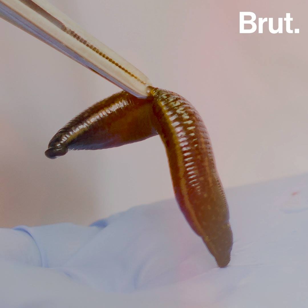 Leeches, a valuable tool in hospitals Brut.