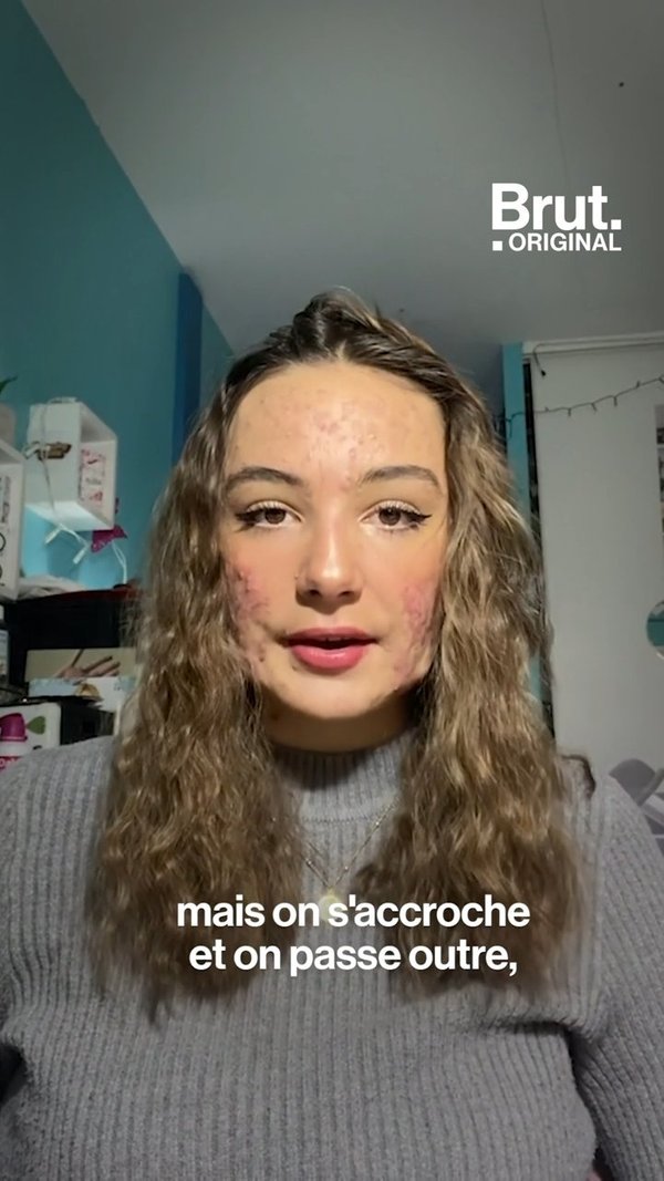 tiktok acne
