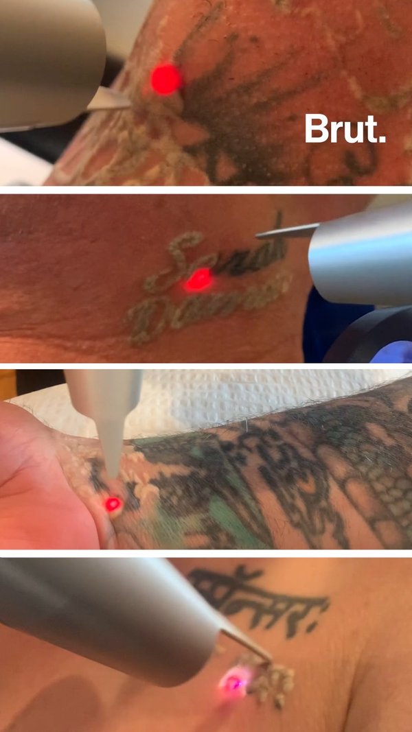 Free tattoo removal to transform lives | Brut.