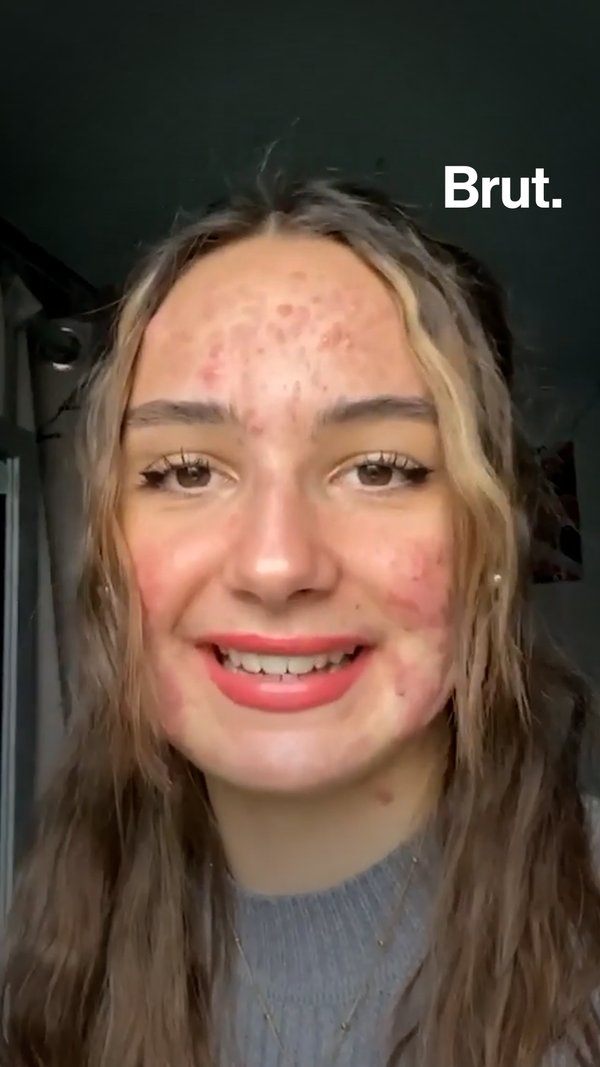 How to feel pretty with acne