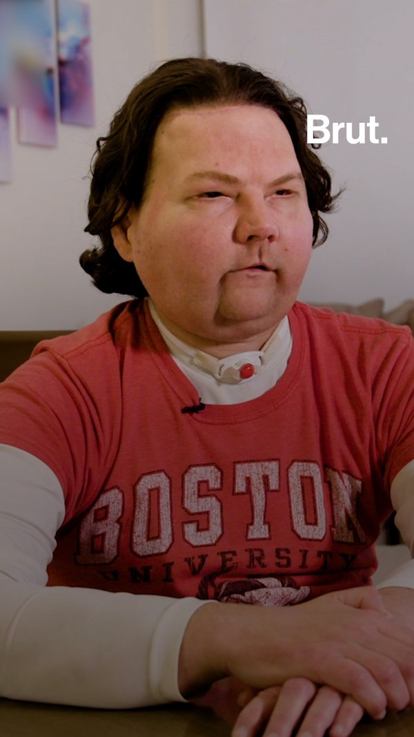 World S First Face And Hands Transplant Brut